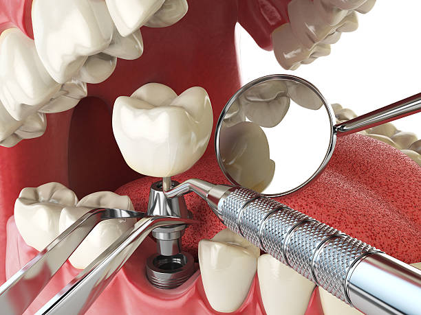 Best Knocked-Out Tooth Emergency  in Lyons, OR